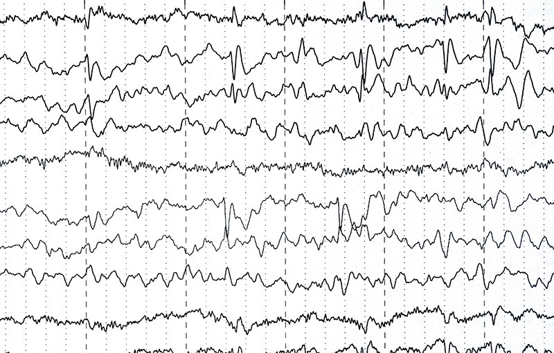 L'électroencéphalographie (EEG) – Speechneurolab