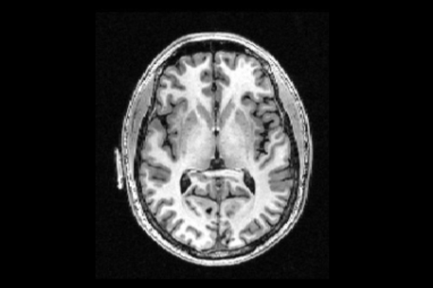 Gray And White Matter Speechneurolab Gray And White Matter Speechneurolab